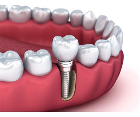 Dental Implants in Yuba City, CA .